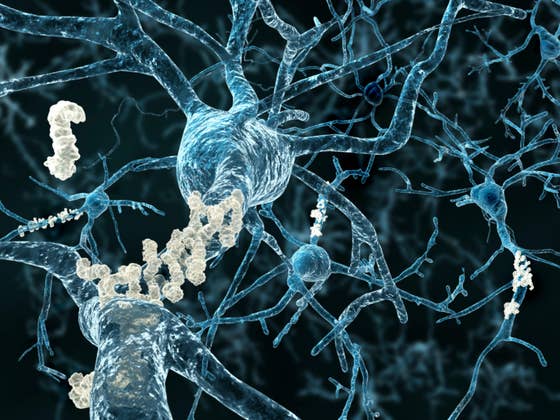 Alzheimer’s Prediction Breakthrough